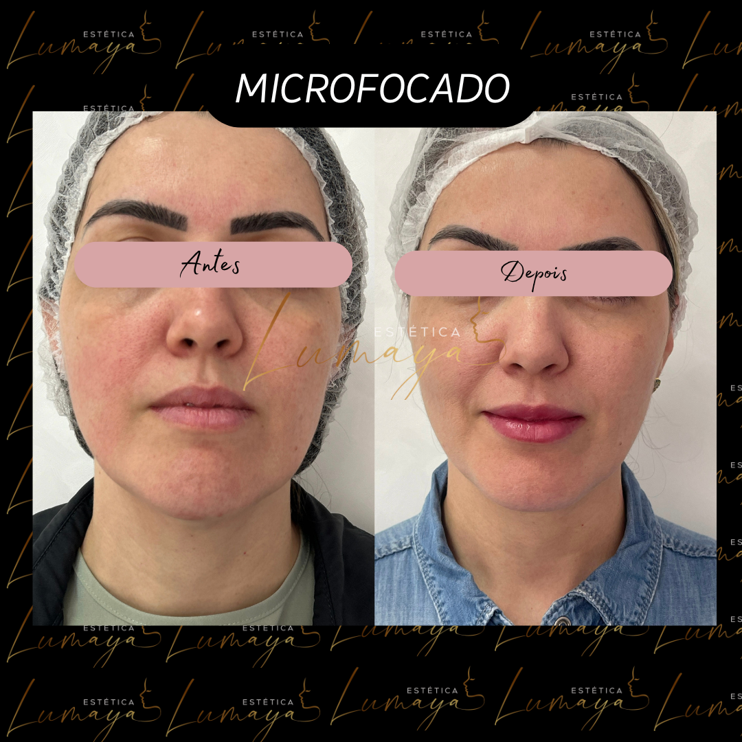Antes e depois ultrassom microfocado Mogi das Cruzes