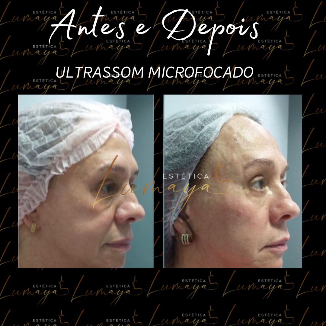 Rejuvenescimento facial sem cirurgia