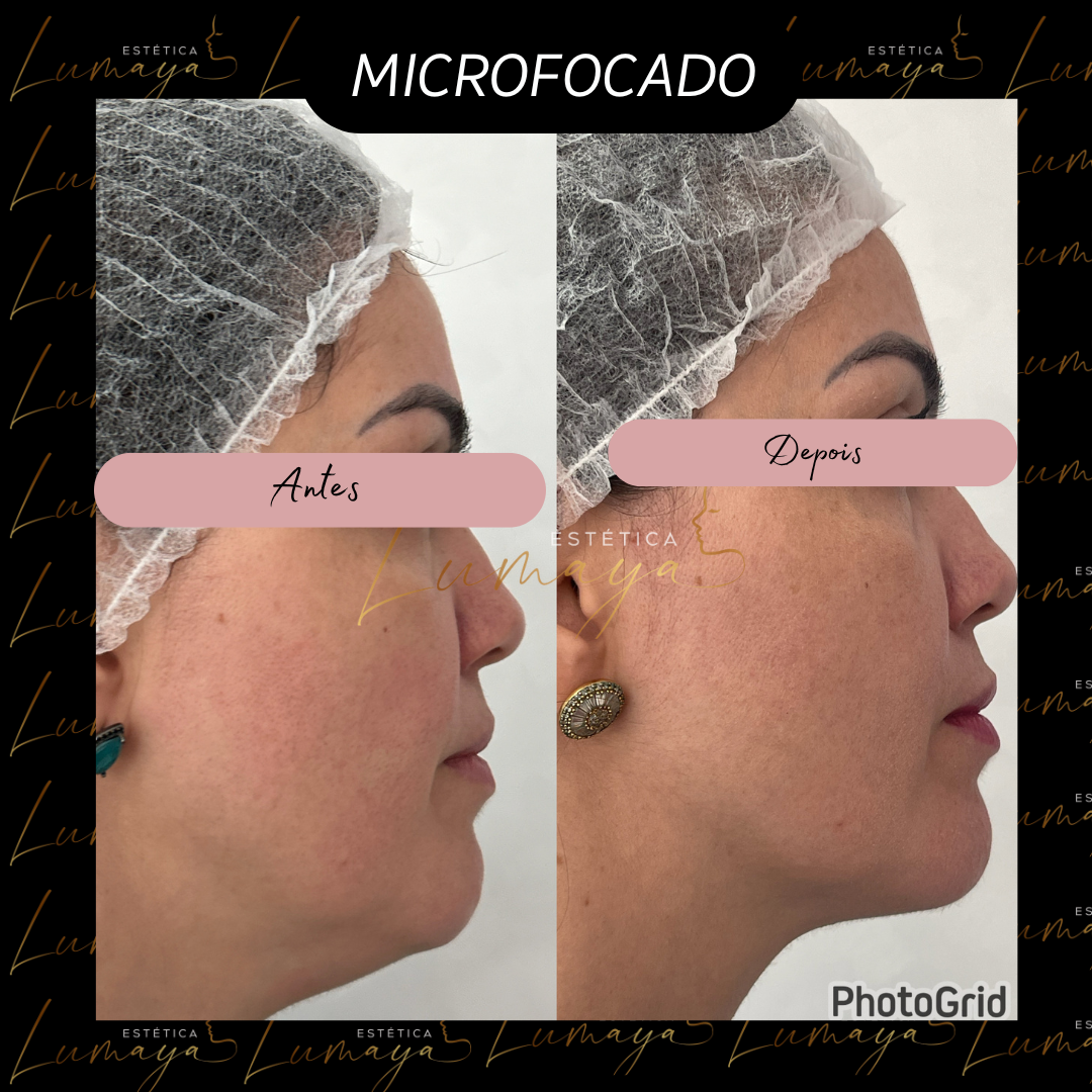 HIFU lifting facial Mogi das Cruzes