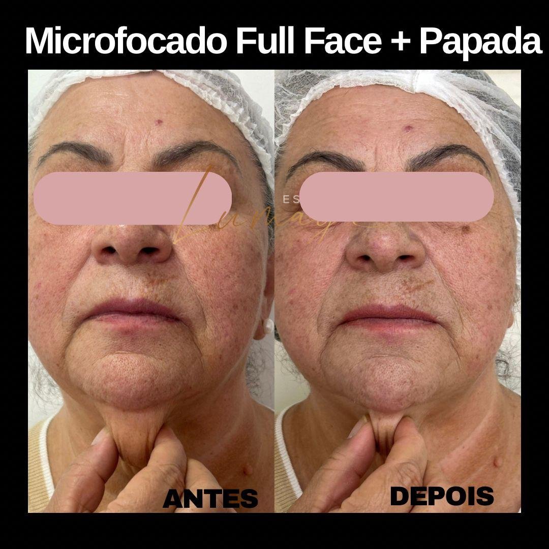 Resultado microfocado Estética Lumaya