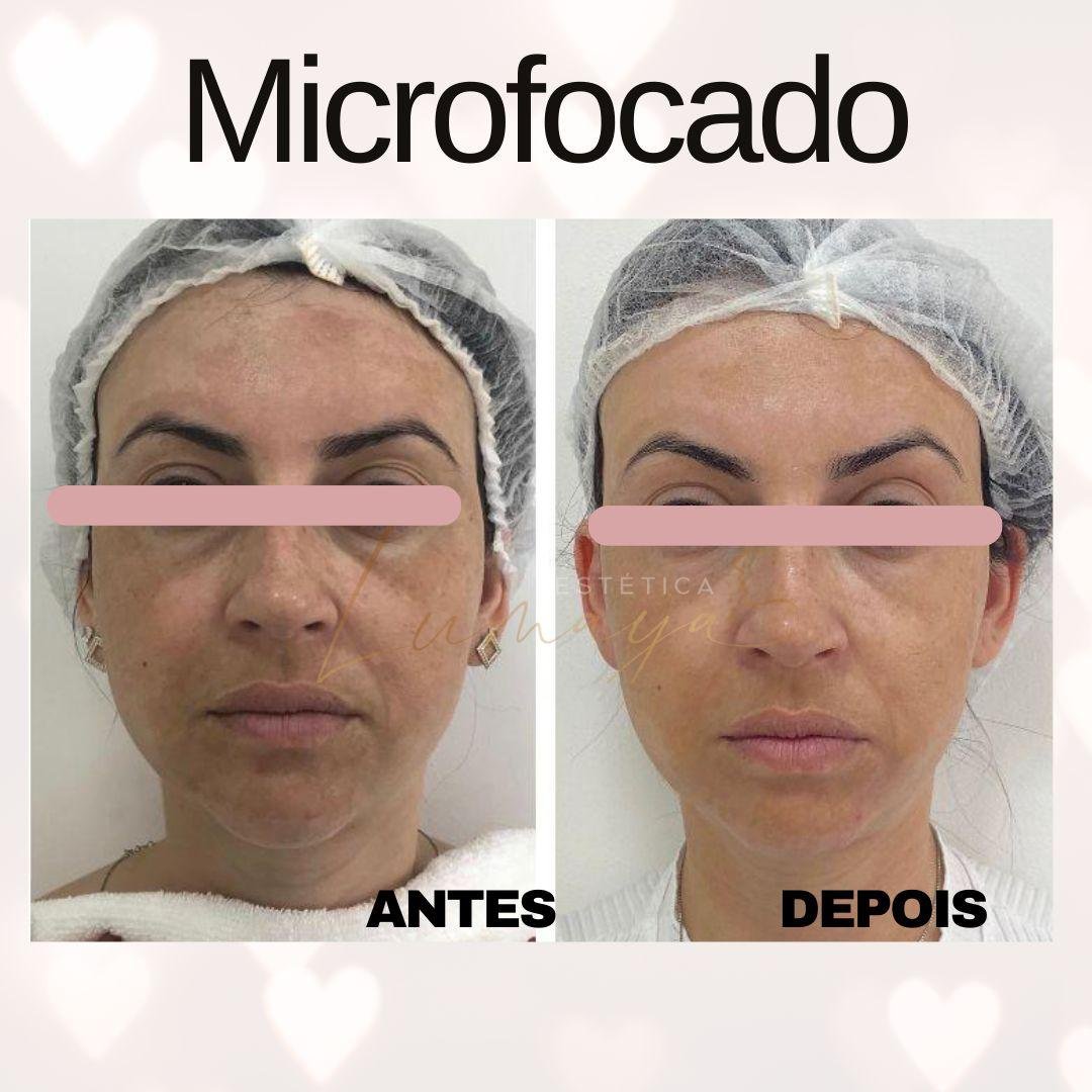 Antes e depois HIFU Mogi das Cruzes