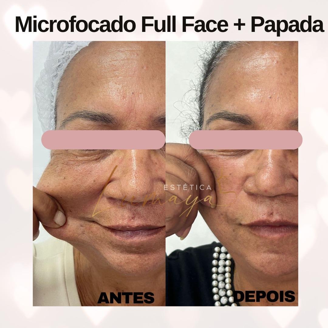 Lifting facial sem cirurgia Mogi das Cruzes
